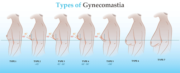 gynecomastia-types