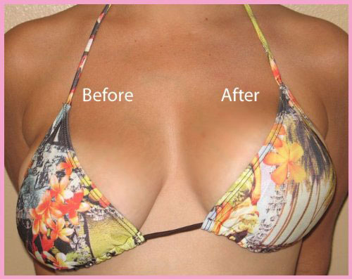 Differences Between Breast Lift Accessories And A Surgical Breast Lift